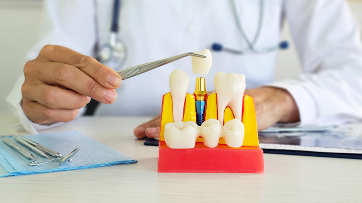 Mão segurando uma pinça em uma prótese dentária 
